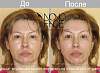 novoface_before_after (2).jpg