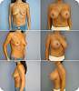 revis_breast_augmentation28.jpg