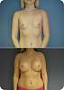 revis_breast_augmentation86.jpg