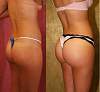 buttocks-implant.jpg