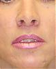 liplift-_427a7b9d98c54.jpg