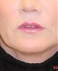 liplift2_4601a86ab664d.jpg