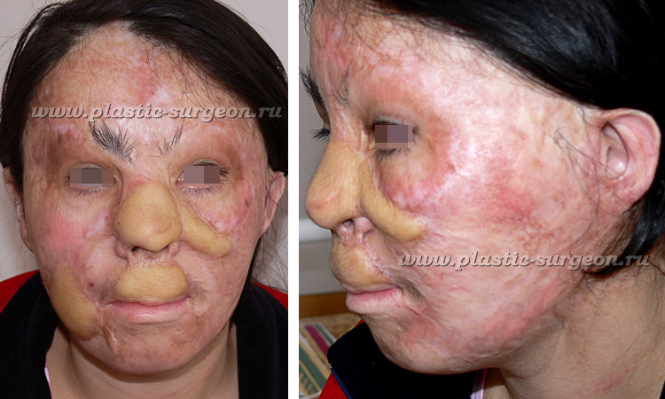 Реконструкция кожи на лице