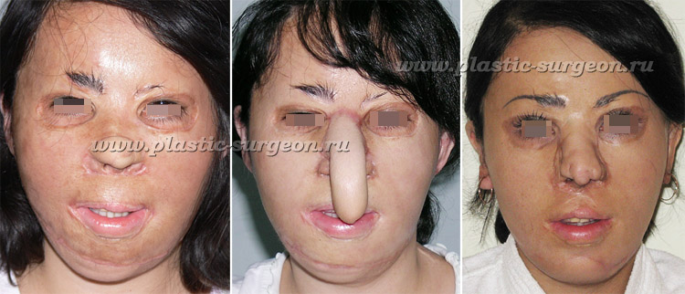 Реконструкция кожи на лице