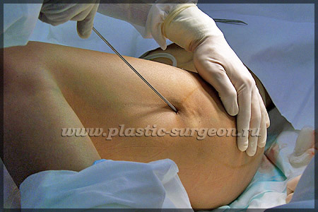 https://plastic-surgeon.ru/files/Statji/lipomammo/lipo1.jpg