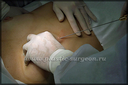 https://plastic-surgeon.ru/files/Statji/lipomammo/otsloyka1.jpg