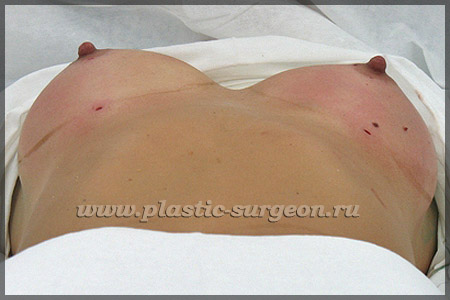 https://plastic-surgeon.ru/files/Statji/lipomammo/second.jpg