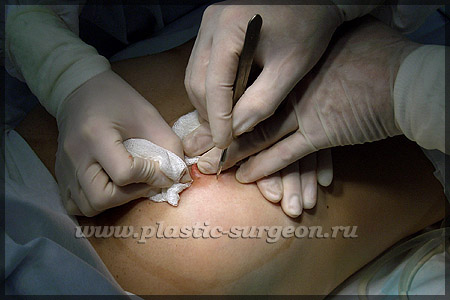 https://plastic-surgeon.ru/files/Statji/lipomammo/start1.jpg