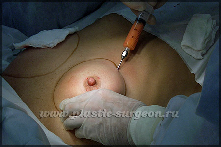 https://plastic-surgeon.ru/files/Statji/lipomammo/ukol1.jpg