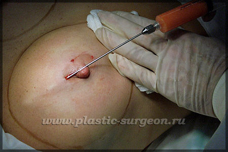 https://plastic-surgeon.ru/files/Statji/lipomammo/ukol2.jpg