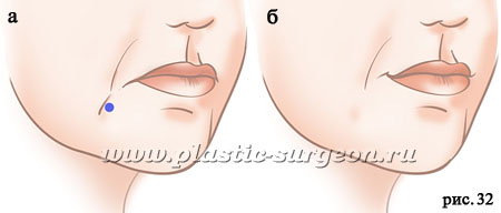 Куда колоть ботокс чтобы поднять уголки губ схема
