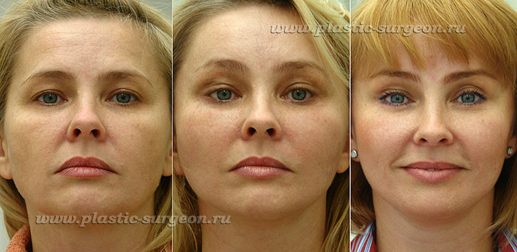Отек на лице после операции фото