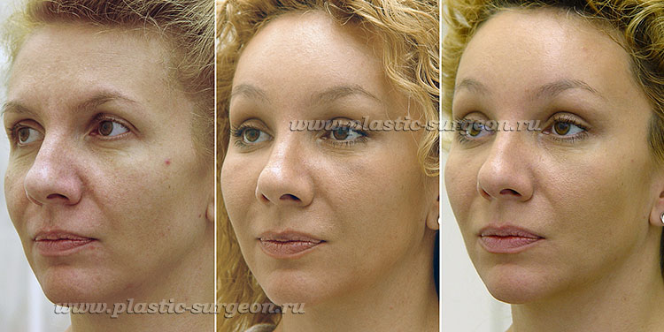 Отеки лица после операций фото