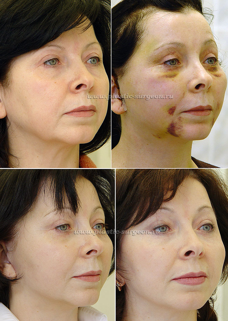 Отек на лице после операции фото до и после