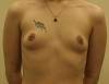 breast1.jpg