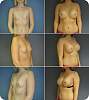 revis_breast_augmentation42.jpg