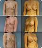revis_breast_augmentation5.jpg