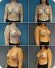breast_aug_revision21.jpg