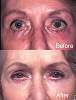 Fixing-eyelids-example-2-L.jpg