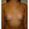 Breast-Augmentation-before-1970139-2336365.JPG