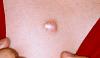 Keloid_1_050808.jpg