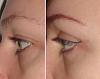 before and after plepharoplasty - .jpg