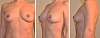 Mar27-breasts.jpg