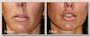lip-lift-before-after-patient-145.jpg